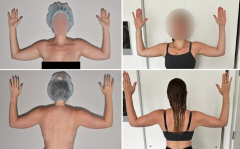 Four images capture a person raising their arms, donning a surgical cap and black clothing, viewed from both the front and back. The context hints at preparation for a liposuction procedure. Faces are blurred to ensure anonymity.