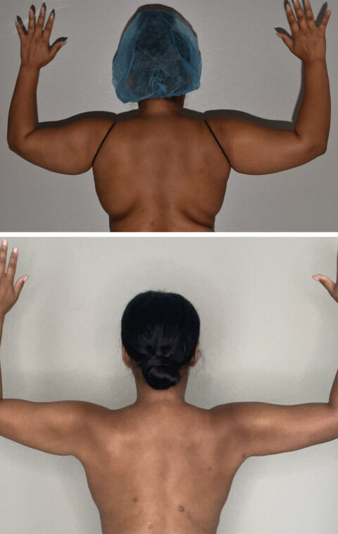 Two images highlighting a transformation in a person's arms: the top shows flexed arms with loose skin, while the bottom reveals a more toned appearance. This change suggests potential cosmetic surgery, such as liposuction, to achieve the refined look.