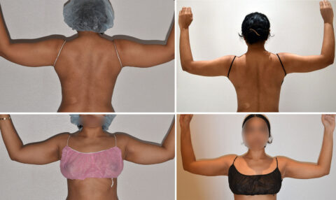 Four images capture the transformative journey of a person's back and arms post-cosmetic surgery. The subject, wearing various tops and with their face obscured, highlights the remarkable impact of liposuction on their silhouette.