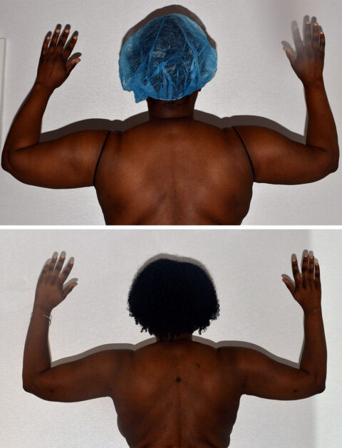 Before and after images reveal the transformation of a person raising their arms; the top image features a surgical cap, while the bottom highlights natural hair. This change subtly underscores the impact of cosmetic surgery on enhancing one's appearance with precision.