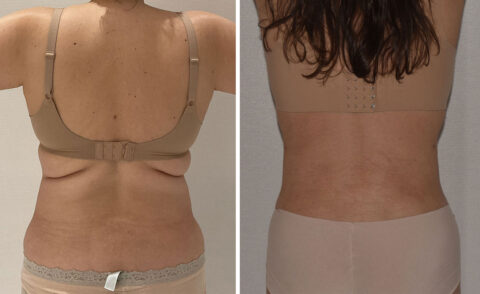 Side by side comparison of a woman's back before and after liposuction, highlighting reduced skin folds and improved skin appearance.