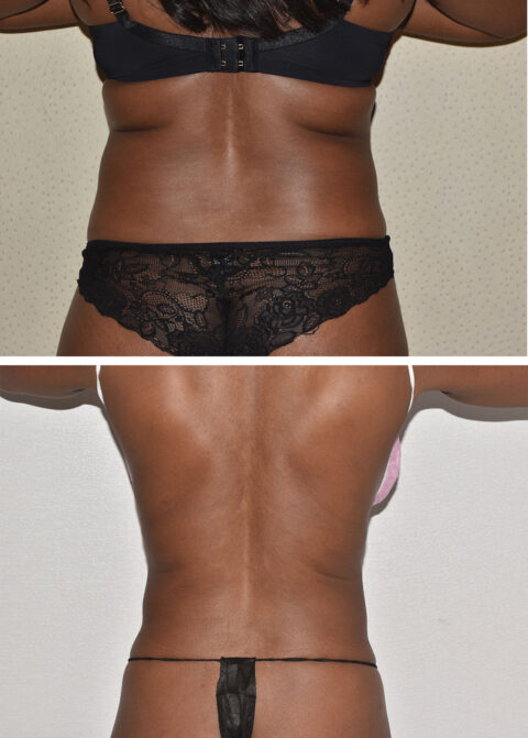 Two images highlighting a person's back: the top showcases a black bra and lace panties, while the bottom reveals a streamlined silhouette in a black thong, possibly post-liposuction.