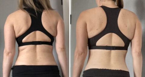 Before-and-after photos of a person from the back, wearing a black sports bra, reveal striking body shape changes post-liposuction.