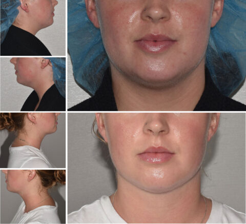 Side and front views of a person's chin and neck are showcased, highlighting before and after changes; a surgical cap makes an appearance in some images. This transformation could be mistaken for an auto draft in nature's design.