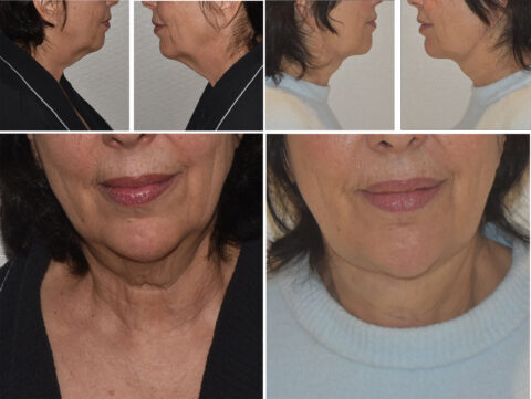 Before and after comparison of a woman's neck and chin area, highlighting skin changes post-liposuction.