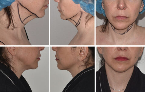 Auto Draft showcases striking before and after images of a cosmetic procedure on a person's neck and jawline, with marked areas in the top row and impressive post-operative results in the bottom row.