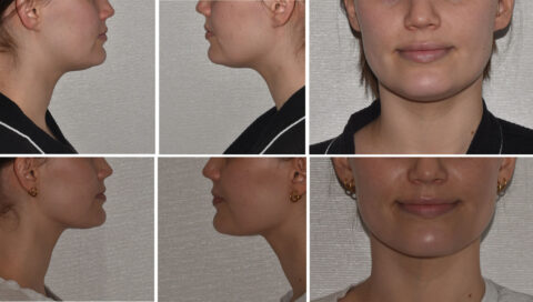 Side and front views of a person's face and neck, focusing on the chin, are shown in three pairs of images, comparing angles and expressions.