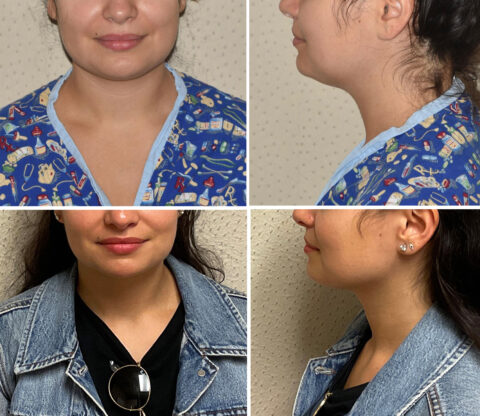 Before and after images reveal a woman in patterned scrubs and denim jacket, effectively showcasing the auto draft of her enhanced jawline and neck profile.