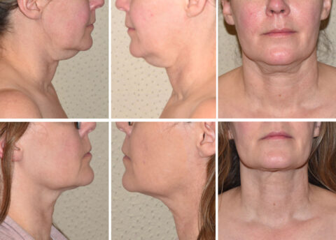 Before and after comparison of a woman's jawline and neck in three angles, highlighting changes in profile and frontal view, while also considering potential instances of paradoxical adipose hyperplasia.