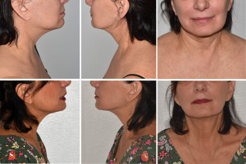 Two sets of before-and-after photos showcase the transformative effects of liposuction on a woman's neck and chin. The images capture side and front views, emphasizing noticeable improvements in contour and skin appearance after the procedure.