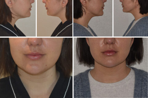 Collage of close-up images showcasing a person's profile from different angles, with an emphasis on lips, chin, and cheeks—each moment captured like an auto draft of fleeting expressions.