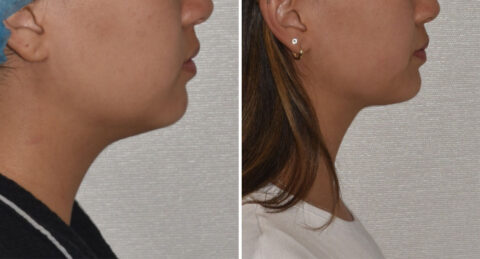 A side-by-side comparison of a woman's profile before and after chin contouring, showcasing a more defined chin and jawline in the second image with precision akin to an auto draft.