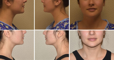 Images showcasing before-and-after side and front views of a person's neck and chin, highlighting the transformative effects of chin liposuction on profile and facial contours.