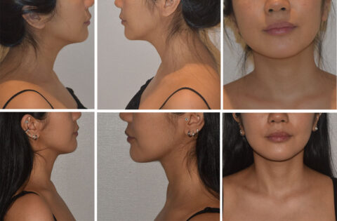 A series of six images showcases before and after side profiles and front views of a person's lower face and neck, highlighting the remarkable transformation in the chin and jawline area, thanks to targeted chin liposuction.