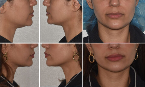 A collage showcasing before and after side and front views of a woman's face and neck, highlighting the transformative effects of chin liposuction on her jawline and chin area.