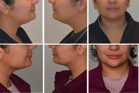 A before-and-after side-by-side comparison of a person's face highlights changes in chin and jawline from various angles, showcasing the impressive results achievable through liposuction.