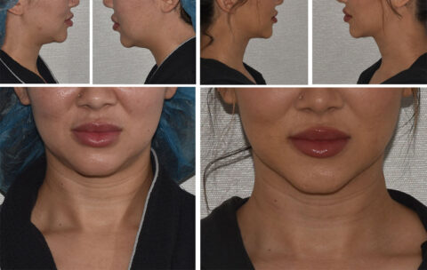 Before and after images of a woman's chin and lip areas, captured from both side and front views, perfectly document the transformation almost like an auto draft, seamlessly illustrating subtle yet significant changes.