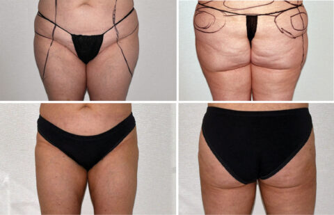 Before and after comparison of a woman's midsection and thighs shows surgical markings. Black underwear accents the transformation, visible both in the top images with marked improvements and in the bottom images showcasing smoother contours.