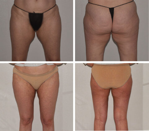 Before and after images of a person's lower body, showcasing the transformation in skin texture and contour as if crafted by an auto draft of nature's hand.