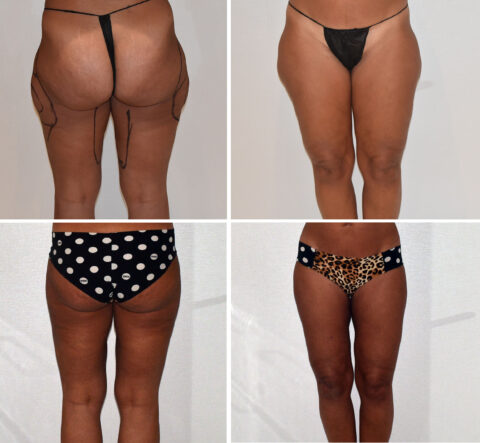 Before and after images of a person showcasing body transformation from liposuction on legs, with different underwear styles, captured from the back and front.