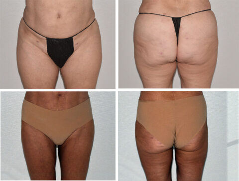 Before and after comparison of a person's lower body, front and back, showcasing the dramatic changes in skin appearance and leg contours with different undergarments post-liposuction.