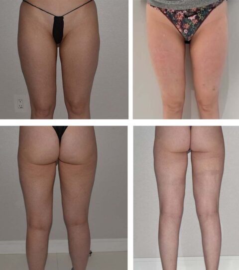 Four side-by-side before-and-after photos, akin to an auto draft in progress, showcase the front and back views of two people's thighs and buttocks, vividly highlighting changes in their appearance.