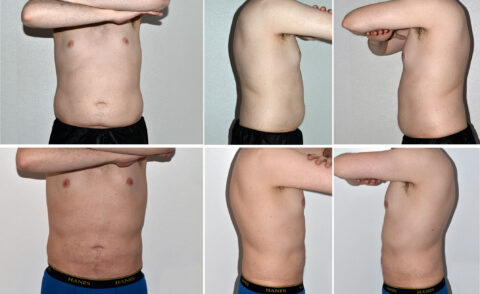 A series of six images showcasing the torso of a shirtless male from different angles, including front and sides, with arms crossed in some views, highlighting the potential results post-liposuction.