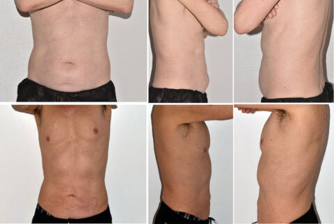 Before and after images of a male torso reveal changes in body shape from different angles, including front and side views, following liposuction.