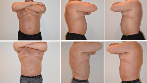 Side-by-side comparison of a male torso from different angles, with arms crossed. Top row: before weight loss. Bottom row: after weight loss and body contouring.