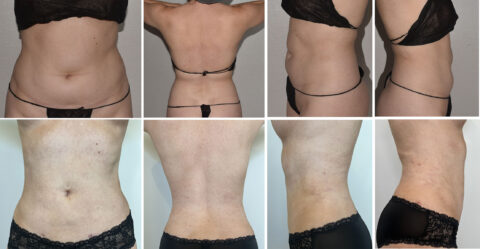 A collage of six images showcasing a person in black underwear, captured from various angles to highlight the waist and midriff area, paradoxically presenting with adipose hyperplasia.