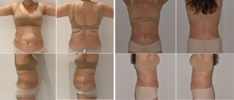 Two sets of photos show a person in underwear, facing different angles: front, left side, back, and right side, to highlight any changes from paradoxical adipose hyperplasia.