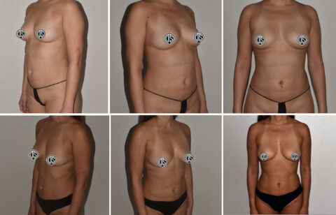 Three side-by-side photos reveal the front and side views of a person in minimal clothing, each labeled with censorship symbols for privacy, highlighting the transformation of the waist and abdomen after Lipo 360.