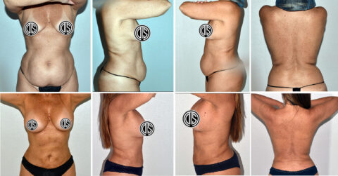 Before and after photos of a woman showing front, side, and back views of her torso, highlighting the transformative results of Lipo 360 on her abdomen and waist. The images focus on notable changes in skin texture and body contours.