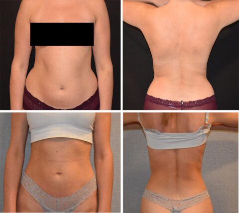 Before and after photos of a person showcase the front and back views, highlighting remarkable body changes around the waist.