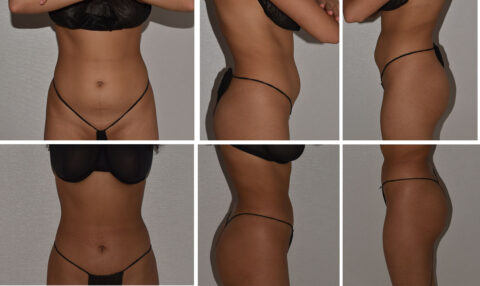 A six-panel image showcases a person in black underwear from various angles—front, side, and back—with a focus on the abdomen and waist, highlighting the transformative results of Lipo 360.