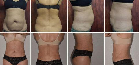 Before-and-after images of a person showcasing transformative changes in the abdomen and waist areas from front, back, and side views.