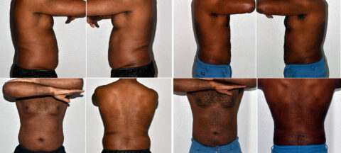 Eight panel image showcasing a person from various angles, emphasizing their abdomen and waist as they raise and lower their arms, set against a plain background. Ideal for illustrating the effects of Lipo 360.