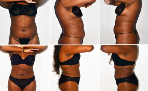 A collage of six images features a person from front and side angles, highlighting the waist in black undergarments against a white background.