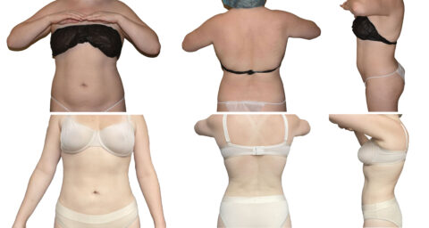 Front, back, and side views of a person wearing underwear, highlighting the waist and abdomen from chest to hips.