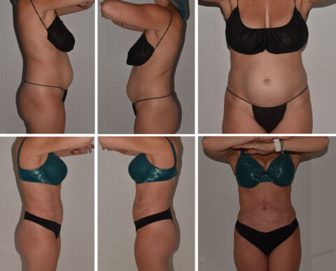 Before and after images of a person showing side and front views. The individual wears different bikinis, highlighting changes in body shape, particularly around the waist, showcasing the impact of Lipo 360 on their abdomen.