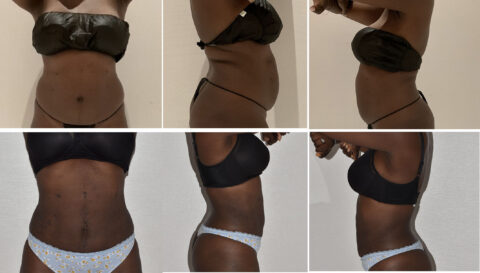 Before and after images display a woman's torso from the front, side, and back, highlighting changes in waist and abdominal appearance following Lipo 360.