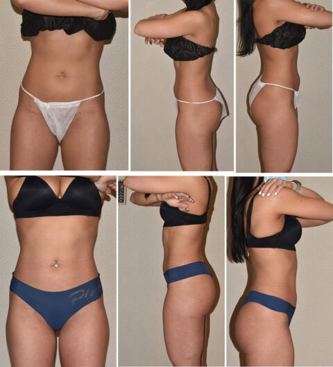 Before and after side-by-side comparison of a woman in black underwear, highlighting posture, abdomen transformation, and body angle changes.