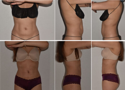 Six side-by-side photos showcase a woman in underwear from front, side, and back angles, highlighting her abdomen and waist in two stunning sets of lingerie: black and beige. It's as if Lipo 360 worked its magic to accentuate every curve with the utmost elegance.