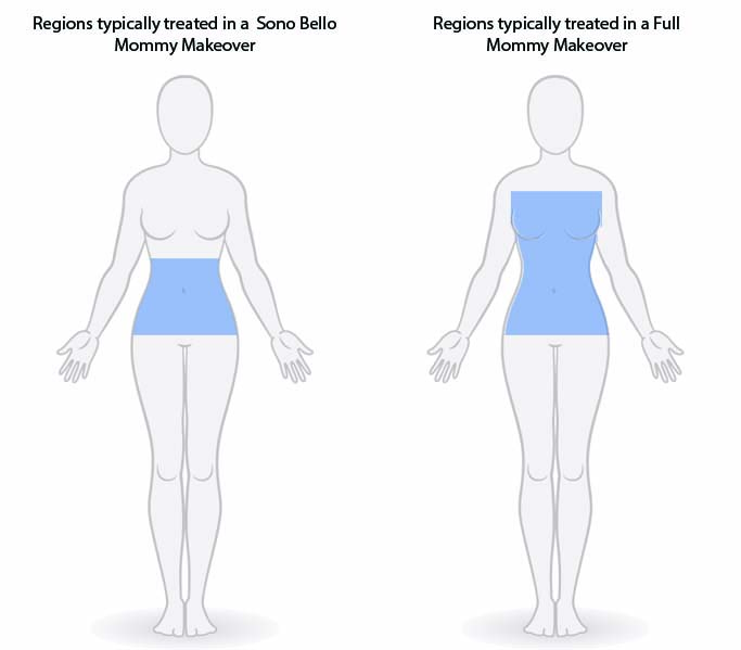 Illustration comparing the focus of Sono Bello versus a Full Mommy Makeover. Sono Bello targets the abdomen, while the Mommy Makeover addresses both the abdomen and chest, highlighted in blue.